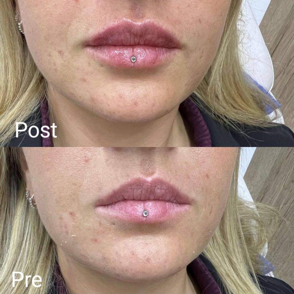 تكبير الشفايف بالفيلر